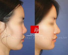 Ribcartilage rhinoplasty - Improvement of mouth protrusion