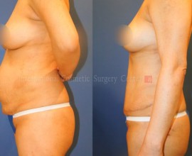 Abdominal surgery + Liposuction