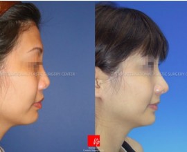 Asian nose with bulbous tip and wide alar - changed as highe…