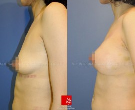 Tear drop breast augmentation