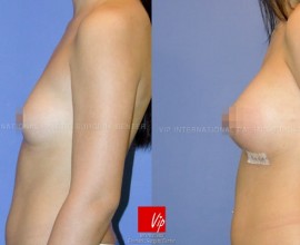 Seven days after tear drop breast surgery