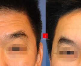 Forehead endoscope surgery-improvement of deep wrinkles