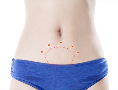 Mini Tummy Tuck incision