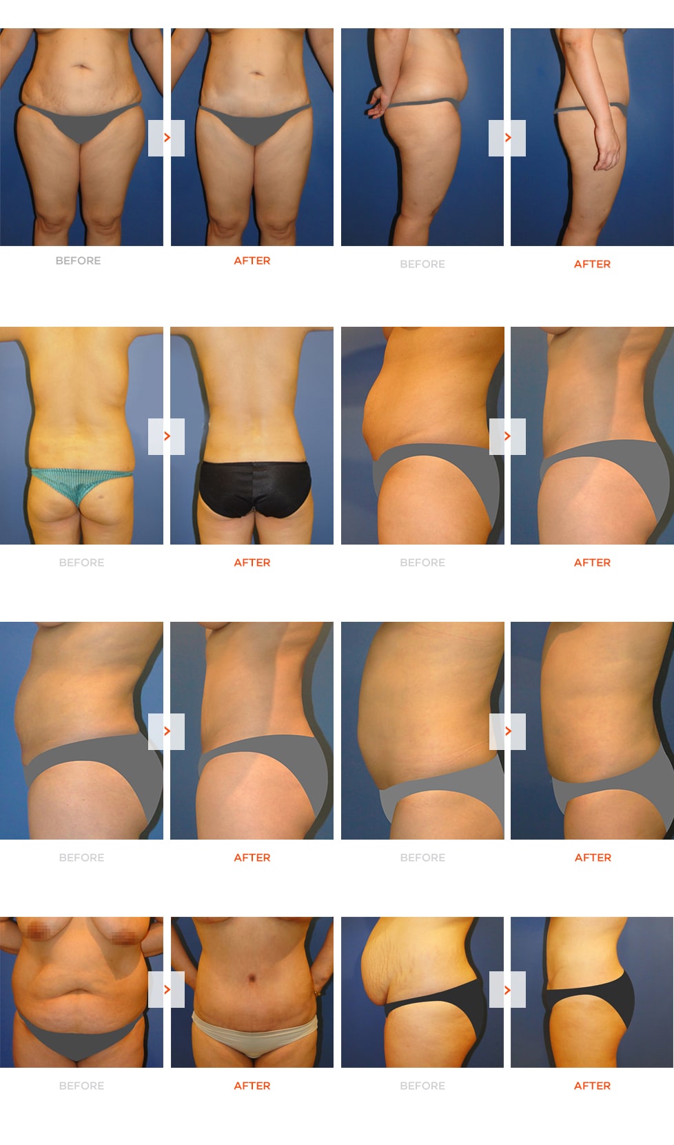 Tummy tuck before and after