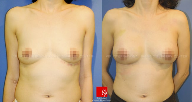 Breast Augmentation Before and After