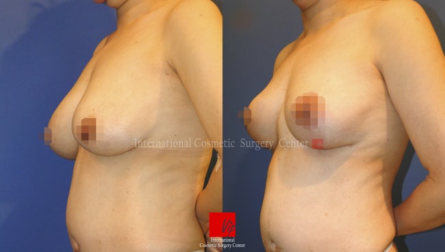 Breast Lift Surgery Before and After