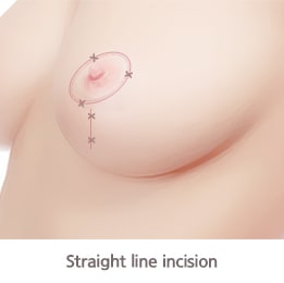 Straight Line Incision(Breast Lift Incision Type)