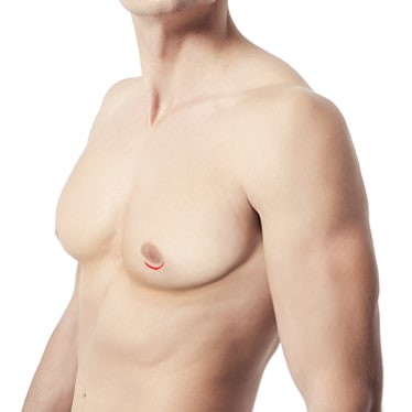Sub-areolar Incision Method of Male Breast Reduction