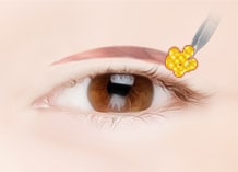Steps for Incision Double Eyelid Surgery Method
