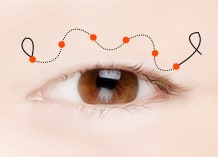 Steps for Incision Double Eyelid Surgery Method