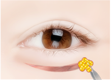 Steps for Lower Eyelid Surgery Method