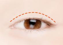 Steps for Incision Ptosis Correction Surgery Method