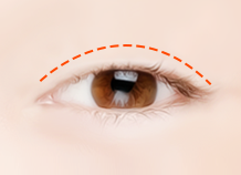 Steps for Non-Incision Ptosis Correction Surgery Method