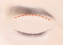 Sub brow lifting surgery method