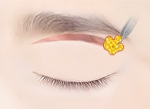 Sub brow lifting surgery method