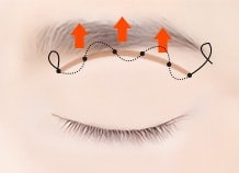 Sub brow lifting surgery method