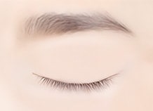 Sub brow lifting surgery method