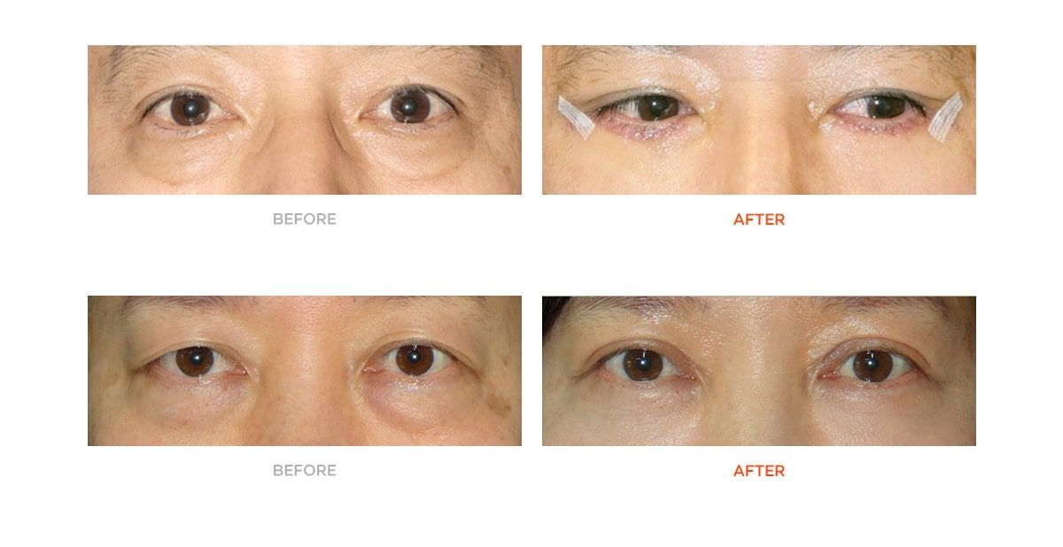 Eye bag surgery before and after