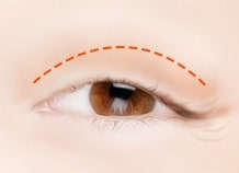 Upper Blepharoplasty (Upper Eyelids) Surgery Method