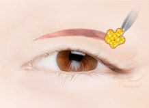 Upper Blepharoplasty (Upper Eyelids) Surgery Method