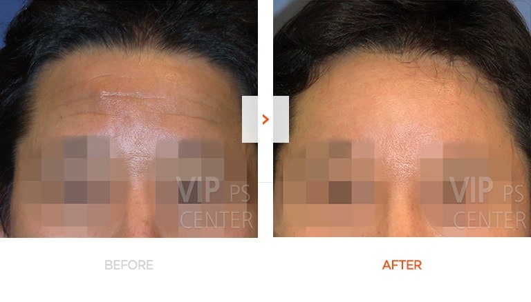 Forehead lift before and after