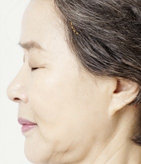 MINIMUM INCISION FACELIFT SURGERY METHOD