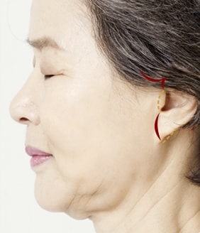 High smas facelift surgery method