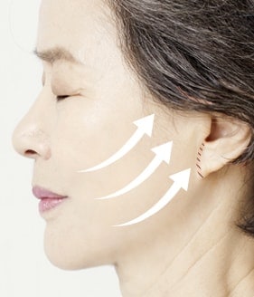 High smas facelift surgery method