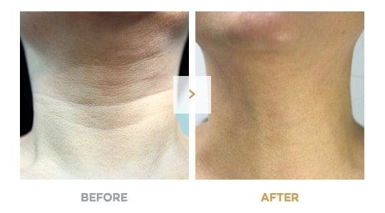Non-Surgical Neck Wrinkle Removal Before and After