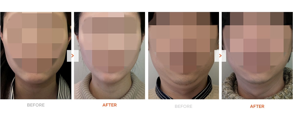 Non surgical v line before and after