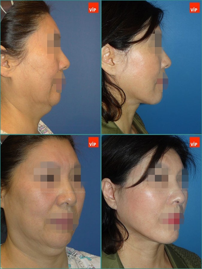 Anti aging surgeries –facelift, necklift