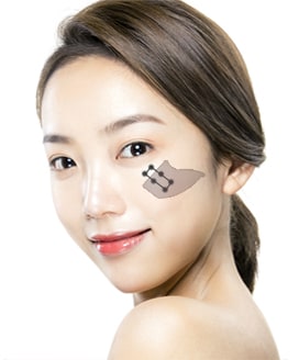 Cheekbone Reduction Surgery Method – Step 5