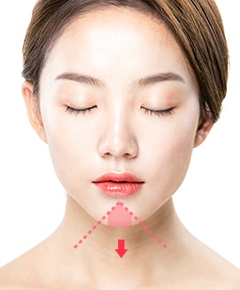 Chin Surgery Method - T-Cut Chin Surgery – Step 1