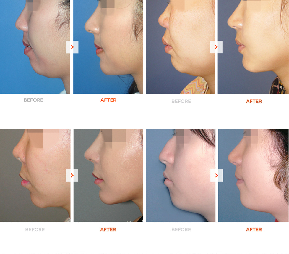 Genioplasty Before and After