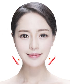 Jaw Reduction Surgery Method – Step 5