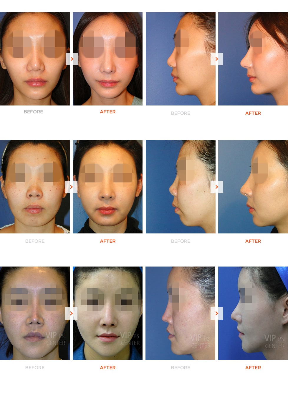 Fat grafting surgery before and after