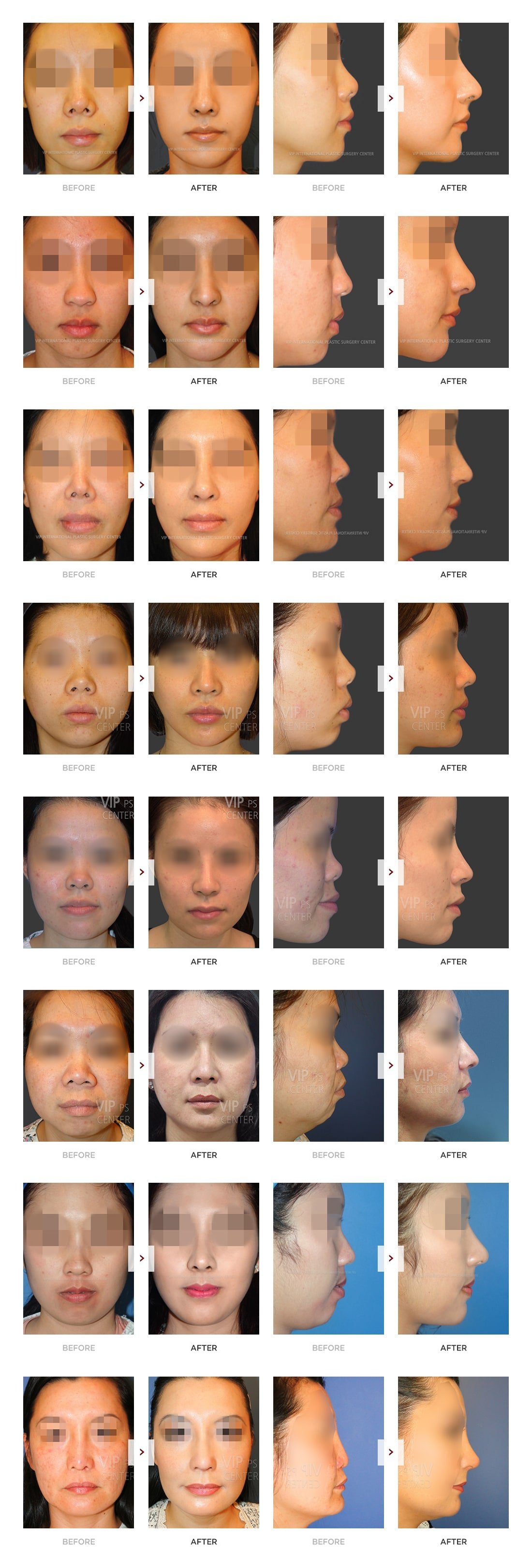 Rhinoplasty Before and After