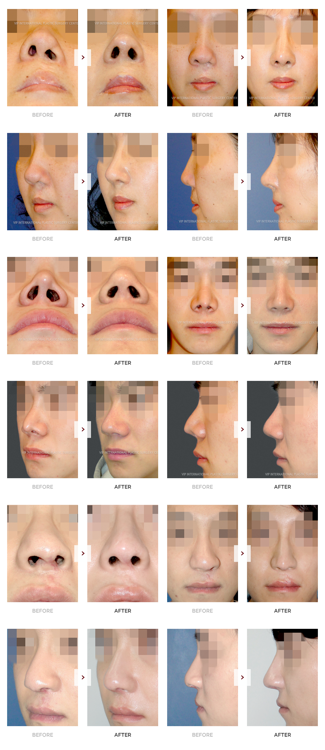 Cleft Lip Rhinoplasty Surgery Before and After