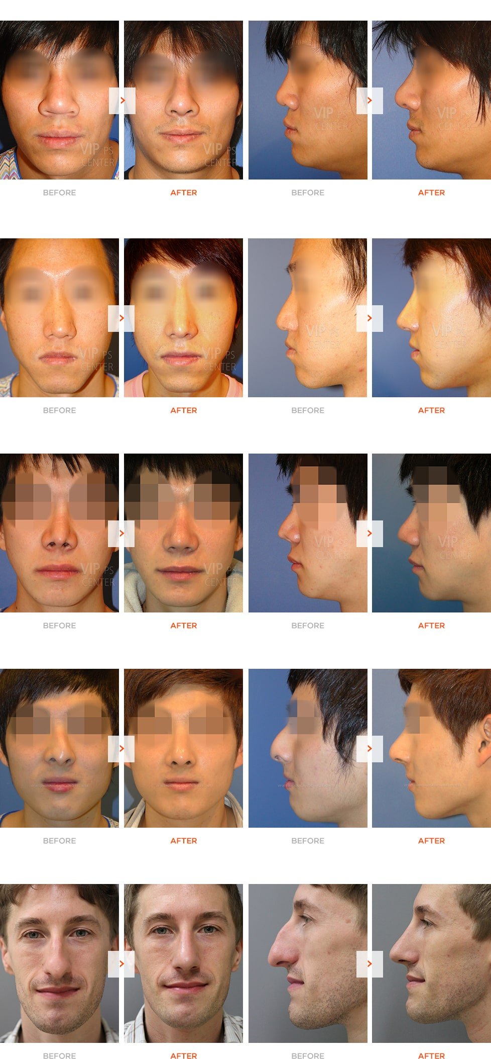 Male Rhinoplasty Before and After