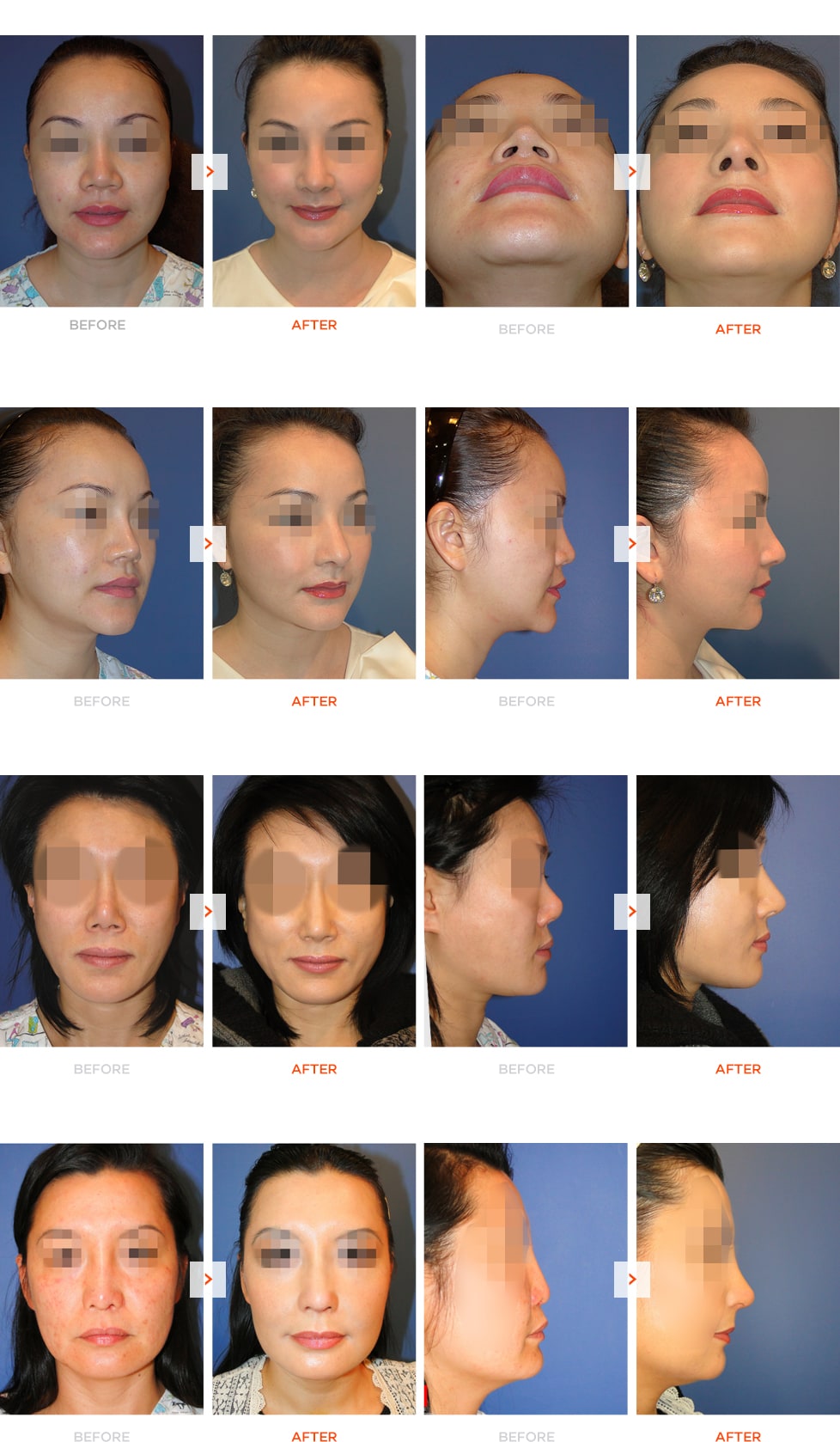 Mid-face augmentation and Rhinoplasty Before and After