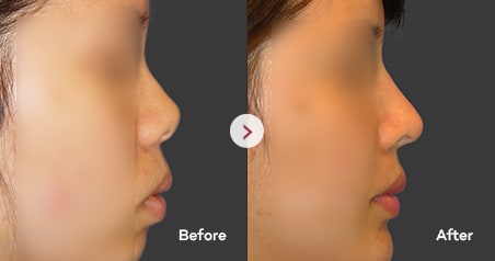 Nose Surgery By Type | Vip Plastic Surgery Korea