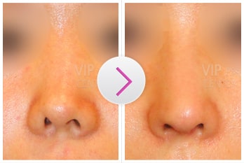 Revision Rhinoplasty Before and After(Deviation)