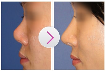 Revision Rhinoplasty Before and After(Upturned Nose)