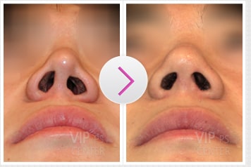 Revision Rhinoplasty Before and After(Asymmetric Nostrills)