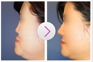 Protruded Mouth Due to Mid-Face Retrusion Before and After