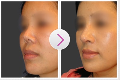Right-Angled Nose Before and After