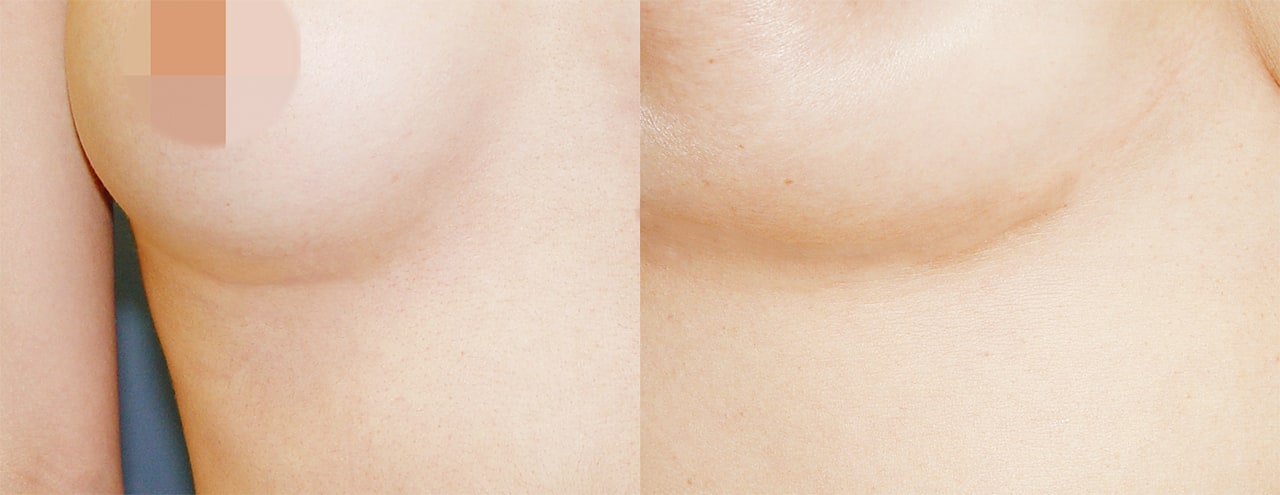For Rib Cartilage Rhinoplasty, VIP Plastic Surgery performs a minimum incision(2-3M) along the line underneath the breast line to minimize the scar.