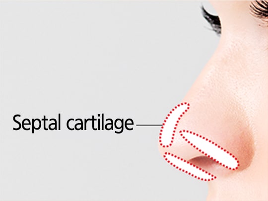 Simple Rhinoplasty Surgery Method (Septal Cartilage)
