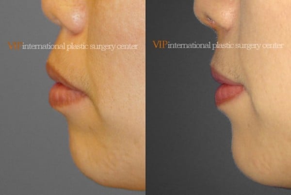 Mouth Protrusion Correction with Rhinoplasty