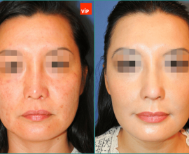 Revision Rhinoplasty for Collapsed Nose with Facial Fat Grafting